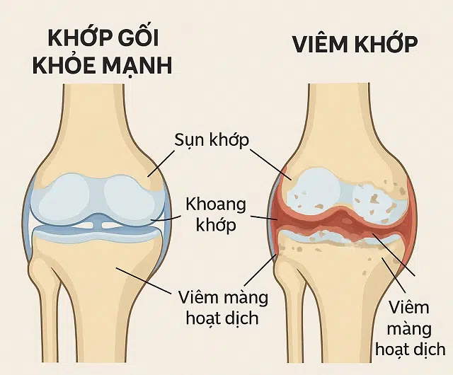 Hinh Anh So Sanh Viem Khop Va Khop Khoe
