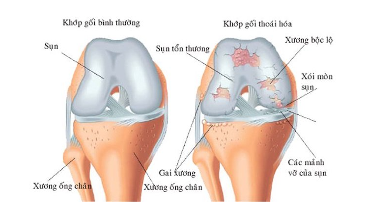 Khop Thoai Hoa Va Khop Khoe Manh