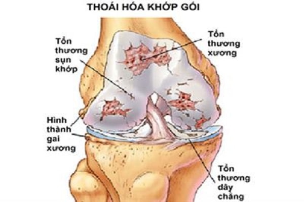 Thoai Hoa Khop Goi La Gi