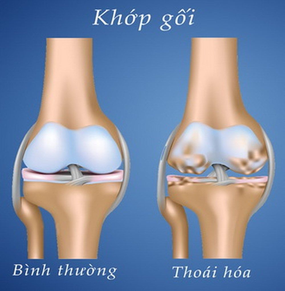 Thoai Hoa Khop Goi Nhu The Nao