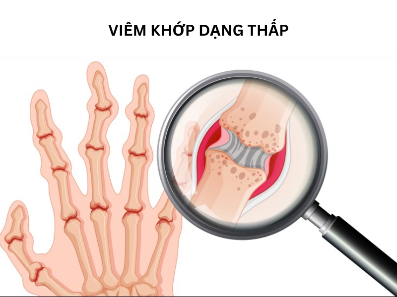 Viem Khop Dang Thap