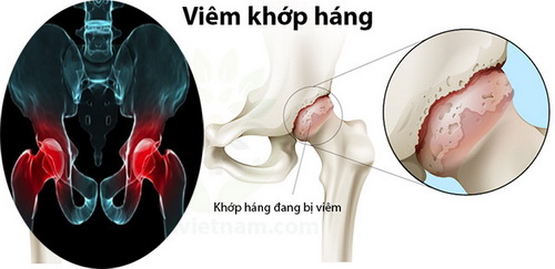 Viem Khop Hang Gay Dau Nhuc