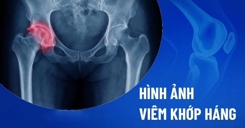 Viem Khop Háng