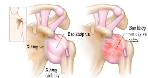 Viem Khop Hau Nhu Ai Cung Bi