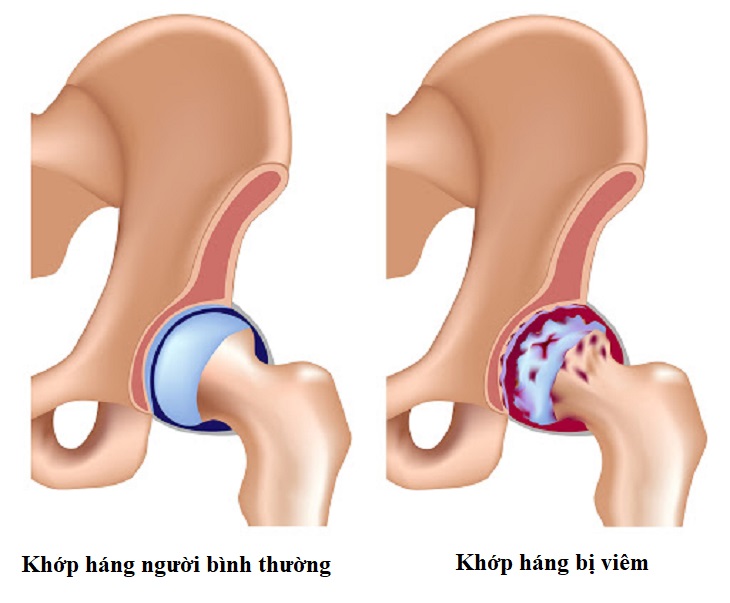 Viem Khop Va Cach Phong Ngua