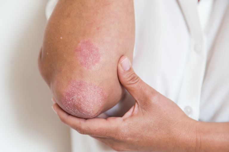 Bệnh Viêm Khớp là Gì - Hiểu Rõ Vấn Đề Khó Nhìn Thấy Nhưng Thường Gặp Ở Mọi Lứa Tuổi