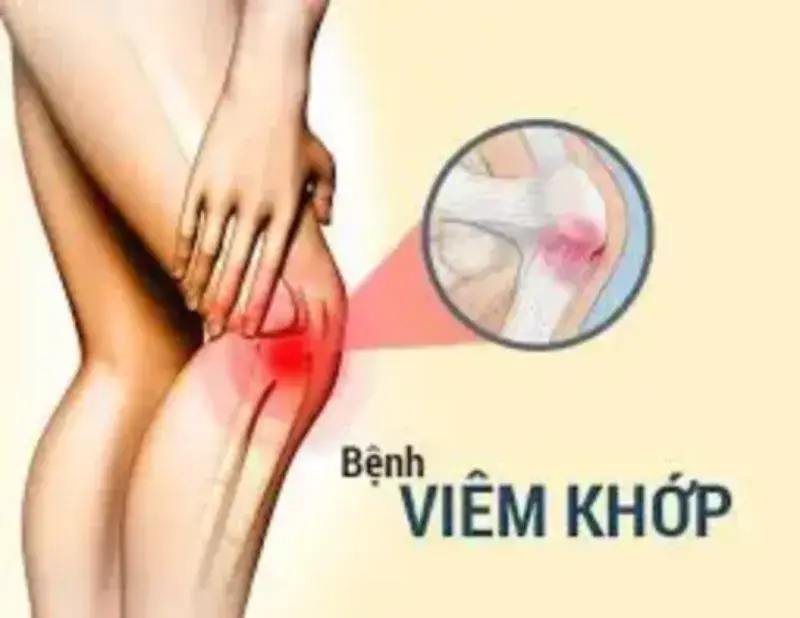 Cách điều trị bệnh viêm khớp hiệu quả