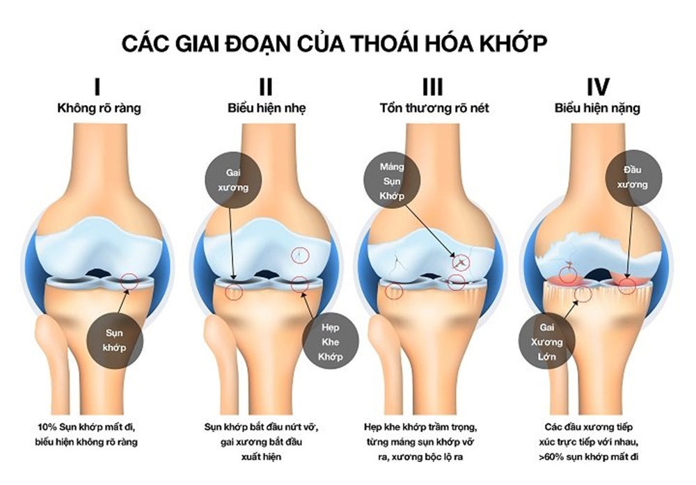 Dieu Tri Thoai Hoa Khop