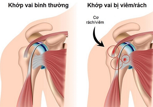 Nguyên nhân gây viêm khớp - Những yếu tố tiềm ẩn và cách phòng tránh hiệu quả