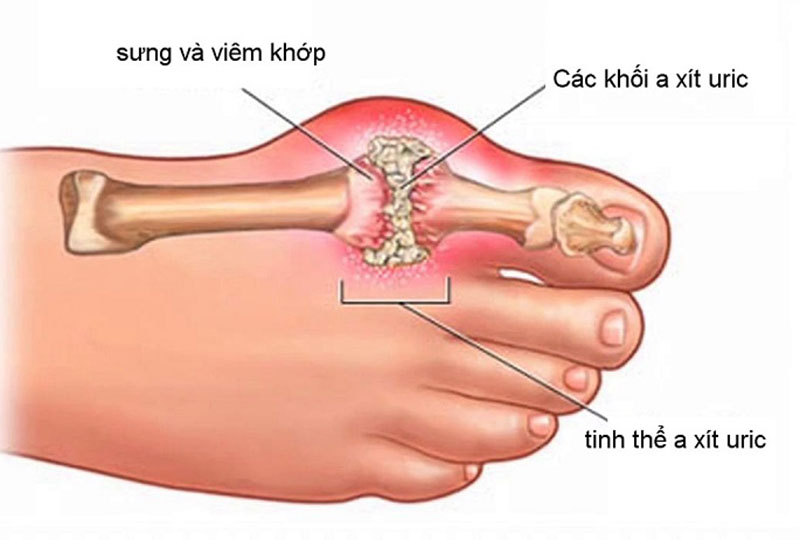 Nguyên nhân gây viêm khớp - Những yếu tố tiềm ẩn và cách phòng tránh hiệu quả