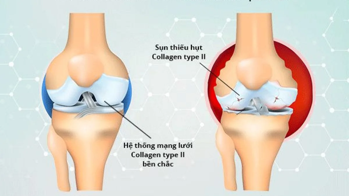 Tac Dung Cua Collagen Voi Xuong Khop