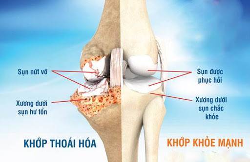 Thoai Hoa Khop (1)