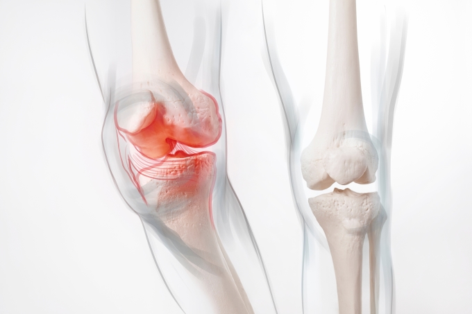 Human,leg,,knee,meniscus,,medically,accurate,representation,of,an,arthritic