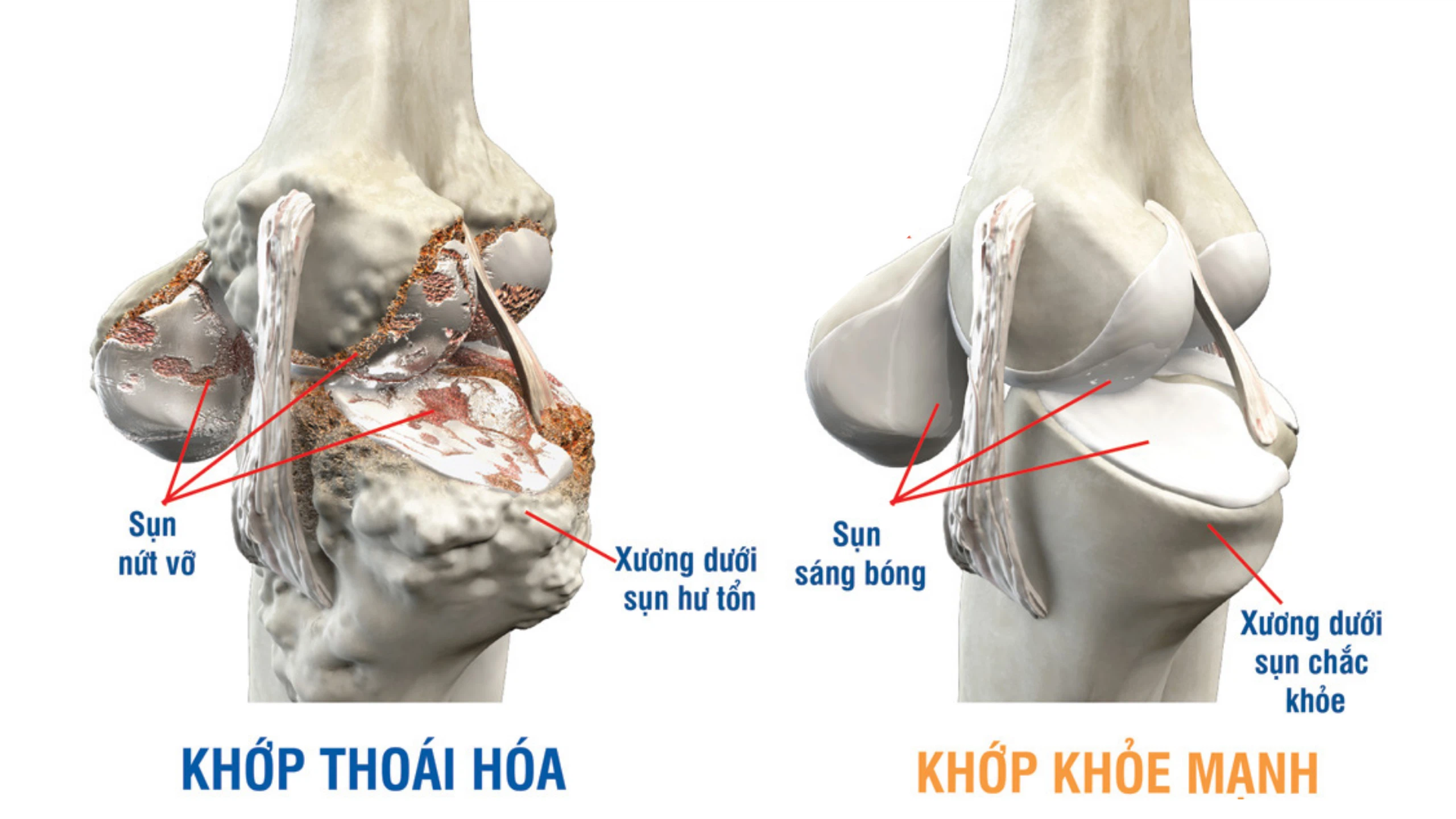 Thoai Hoa Khop