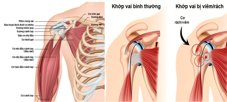 Viêm Khớp Có Khỏi Hoàn Toàn Không? Những Gì Bạn Cần Biết Về Chẩn Đoán, Điều Trị Và Phòng Ngừa