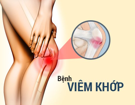 Viem Khop Nen Uong Gi2 1672836283998464548029