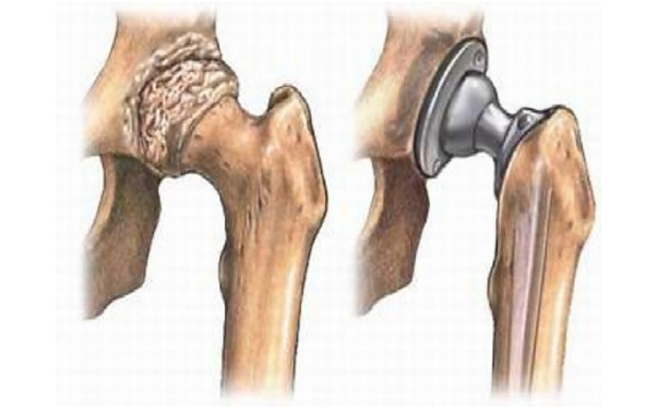 Thoái hóa khớp háng - Nhận diện sớm để bảo vệ xương khớp của bạn tốt hơn