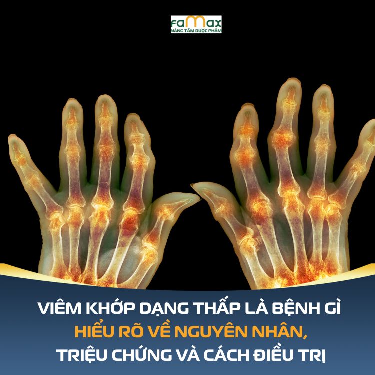 Viem Khop Dang Thap La Benh Gi 6916ef3d147ab.webp