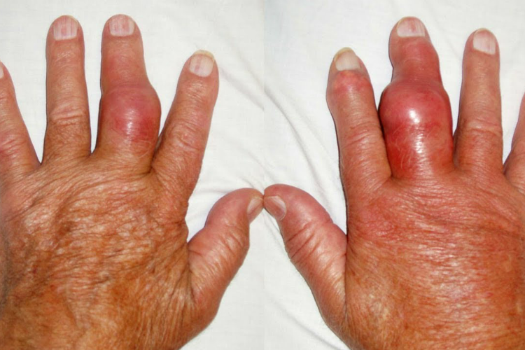 Viêm khớp vảy nến - Bệnh lý ảnh hưởng đến chất lượng cuộc sống của người bệnh