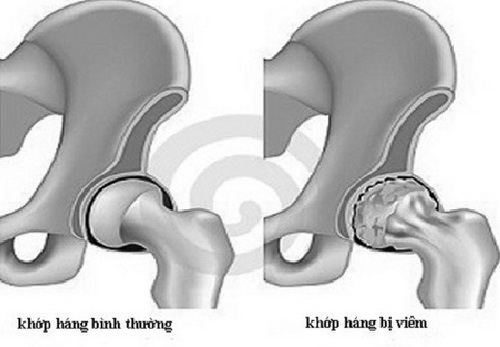 Đau khớp háng do đâu - Nguyên nhân, dấu hiệu và cách phòng ngừa hiệu quả