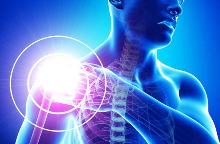 Viêm khớp vai - Những điều cần biết để chăm sóc và điều trị hiệu quả